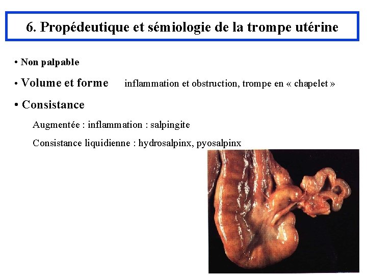 6. Propédeutique et sémiologie de la trompe utérine • Non palpable • Volume et