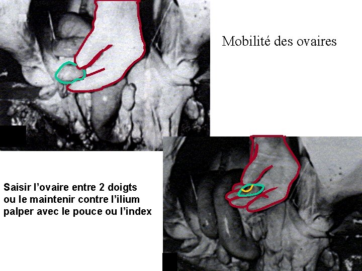 Mobilité des ovaires Saisir l’ovaire entre 2 doigts ou le maintenir contre l’ilium palper