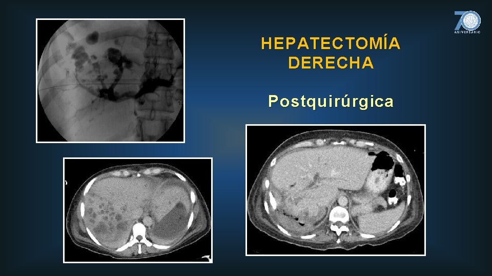 HEPATECTOMÍA DERECHA Postquirúrgica 