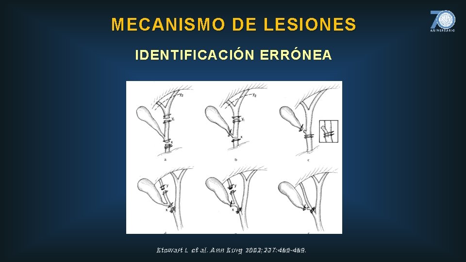 MECANISMO DE LESIONES IDENTIFICACIÓN ERRÓNEA Stewart L et al. Ann Surg 2003; 237: 460