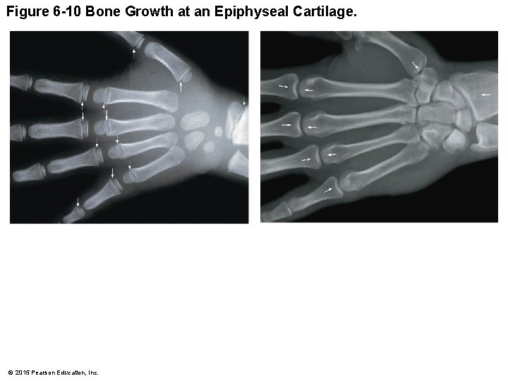 Figure 6 -10 Bone Growth at an Epiphyseal Cartilage. © 2015 Pearson Education, Inc.