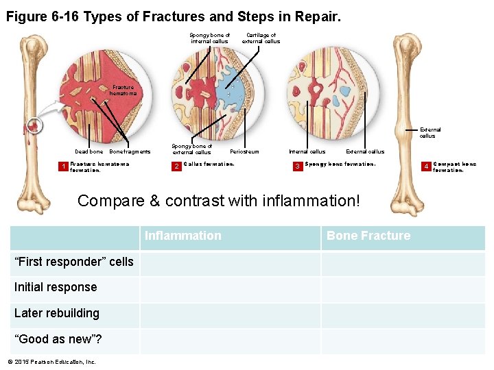 Figure 6 -16 Types of Fractures and Steps in Repair. Spongy bone of internal