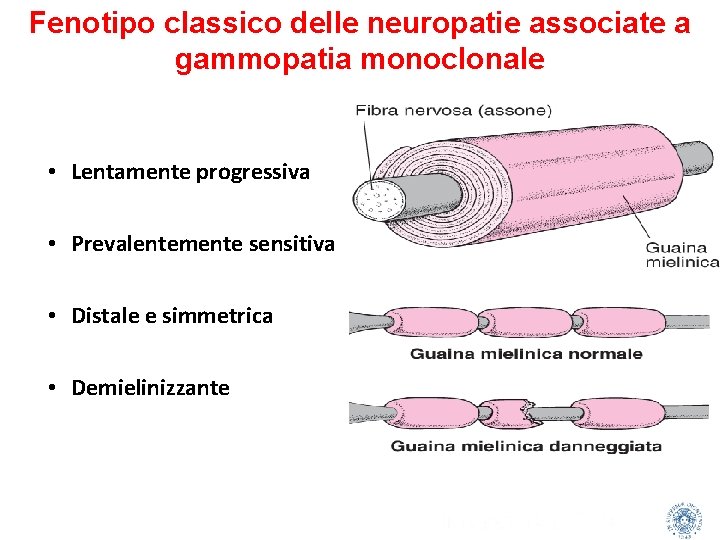 Fenotipo classico delle neuropatie associate a gammopatia monoclonale • Lentamente progressiva • Prevalentemente sensitiva