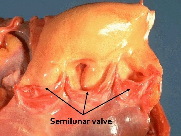 Semilunar valve 