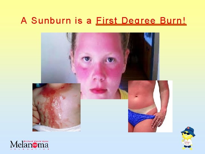 A Sunburn is a First Degree Burn! 