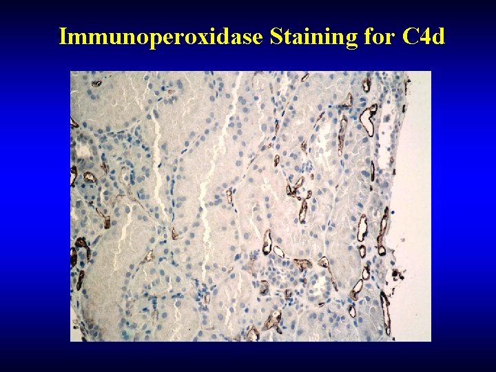 Immunoperoxidase Staining for C 4 d 