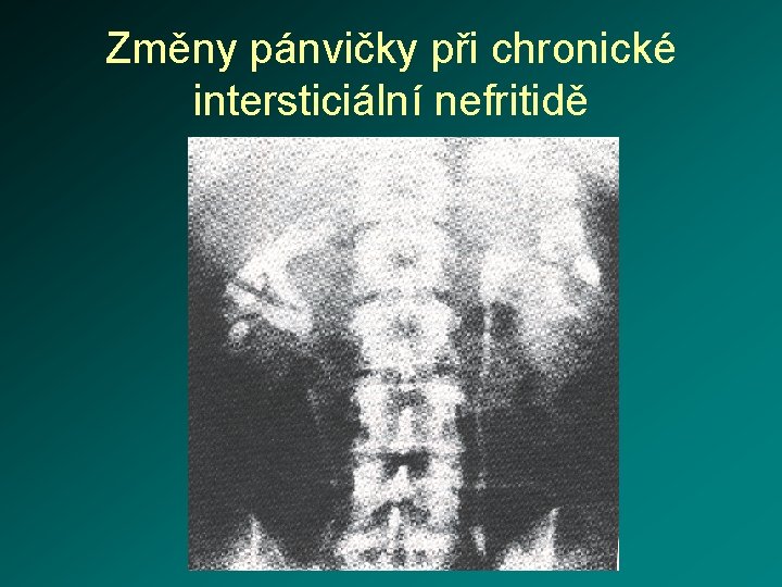 Změny pánvičky při chronické intersticiální nefritidě 