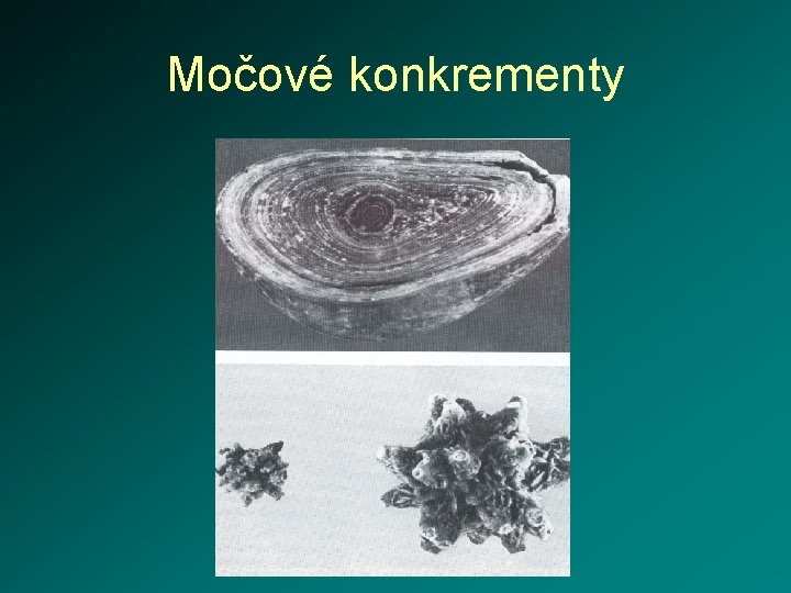 Močové konkrementy 