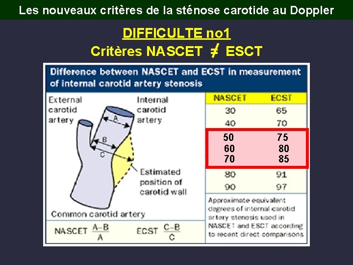 Les nouveaux critères de la sténose carotide au Doppler DIFFICULTE no 1 Critères NASCET