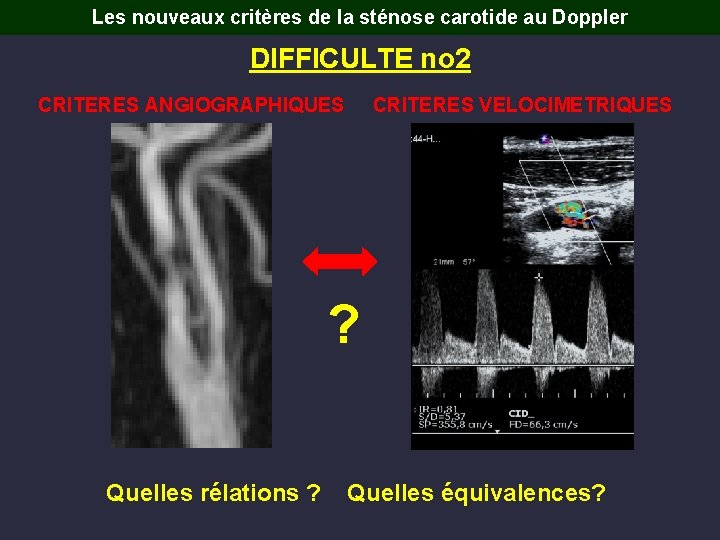 Les nouveaux critères de la sténose carotide au Doppler DIFFICULTE no 2 CRITERES ANGIOGRAPHIQUES