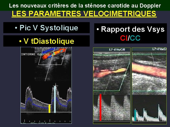 Les nouveaux critères de la sténose carotide au Doppler LES PARAMETRES VELOCIMETRIQUES • Pic