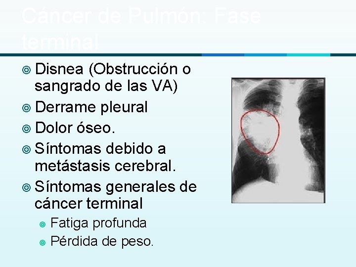 Cáncer de Pulmón: Fase terminal ¥ Disnea (Obstrucción o sangrado de las VA) ¥