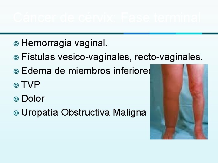 Cáncer de cérvix: Fase terminal ¥ Hemorragia vaginal. ¥ Fístulas vesico-vaginales, recto-vaginales. ¥ Edema