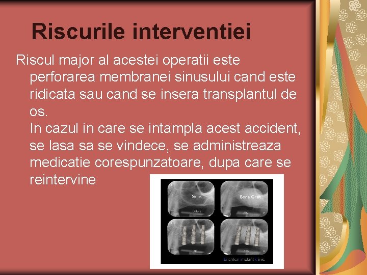 Riscurile interventiei Riscul major al acestei operatii este perforarea membranei sinusului cand este ridicata