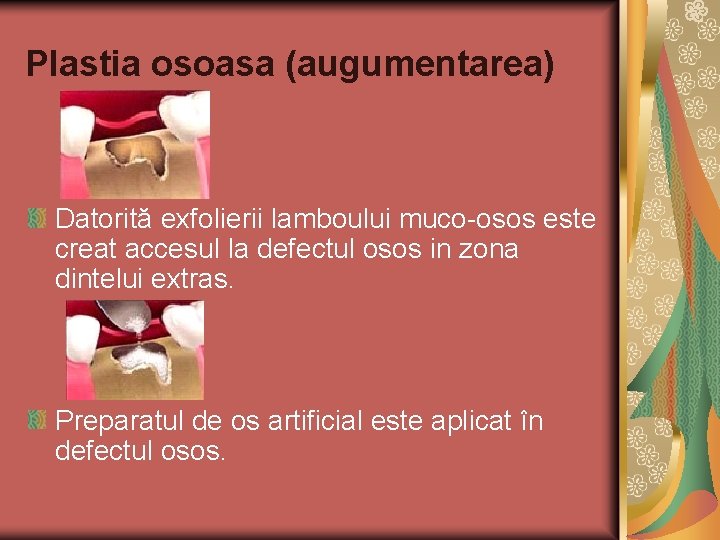 Plastia osoasa (augumentarea) Datorită exfolierii lamboului muco-osos este creat accesul la defectul osos in