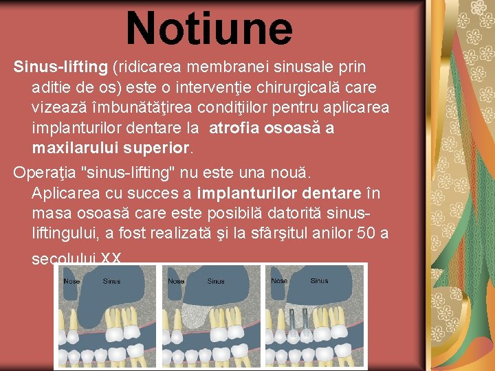 Notiune Sinus-lifting (ridicarea membranei sinusale prin aditie de os) este o intervenţie chirurgicală care