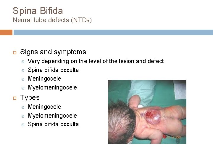 Spina Bifida Neural tube defects (NTDs) Signs and symptoms Vary depending on the level Spina Bifida Neural tube defects (NTDs) Signs and symptoms Vary depending on the level