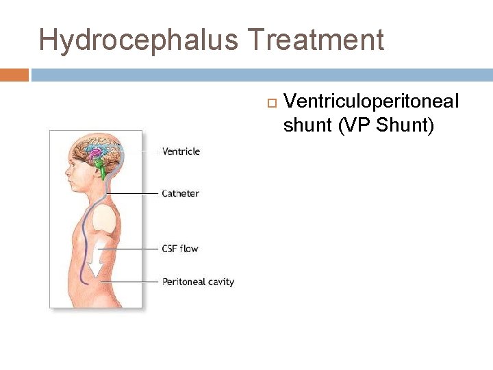 Hydrocephalus Treatment Ventriculoperitoneal shunt (VP Shunt) Hydrocephalus Treatment Ventriculoperitoneal shunt (VP Shunt)