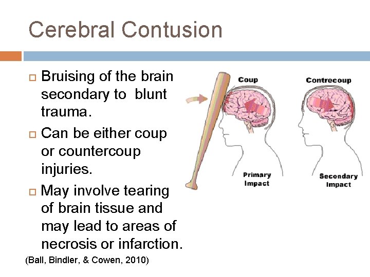 Cerebral Contusion Bruising of the brain secondary to blunt trauma. Can be either coup Cerebral Contusion Bruising of the brain secondary to blunt trauma. Can be either coup