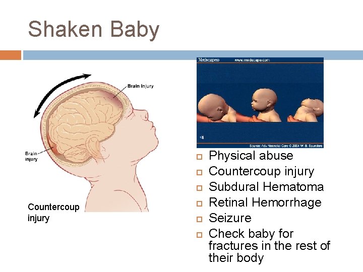 Shaken Baby Countercoup injury Physical abuse Countercoup injury Subdural Hematoma Retinal Hemorrhage Seizure Check Shaken Baby Countercoup injury Physical abuse Countercoup injury Subdural Hematoma Retinal Hemorrhage Seizure Check