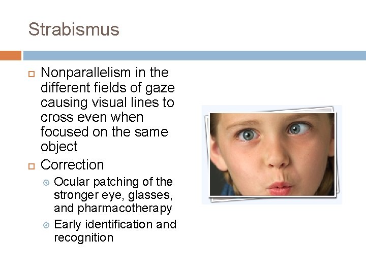 Strabismus Nonparallelism in the different fields of gaze causing visual lines to cross even Strabismus Nonparallelism in the different fields of gaze causing visual lines to cross even