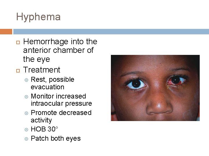 Hyphema Hemorrhage into the anterior chamber of the eye Treatment Rest, possible evacuation Monitor Hyphema Hemorrhage into the anterior chamber of the eye Treatment Rest, possible evacuation Monitor