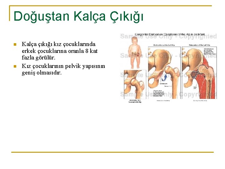 Doğuştan Kalça Çıkığı n n Kalça çıkığı kız çocuklarında erkek çocuklarına oranla 8 kat Doğuştan Kalça Çıkığı n n Kalça çıkığı kız çocuklarında erkek çocuklarına oranla 8 kat