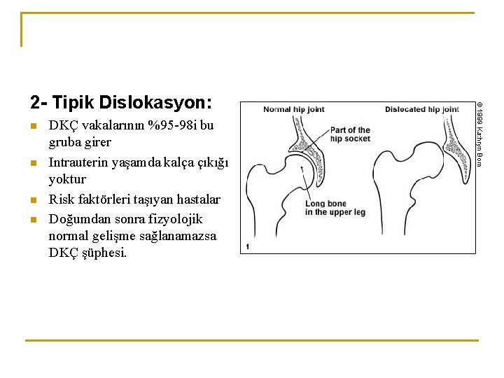 2 - Tipik Dislokasyon: n n DKÇ vakalarının %95 -98 i bu gruba girer 2 - Tipik Dislokasyon: n n DKÇ vakalarının %95 -98 i bu gruba girer