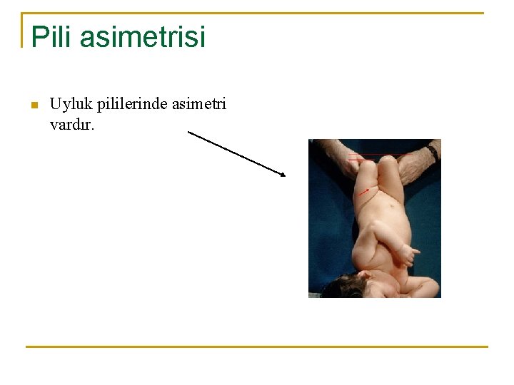 Pili asimetrisi n Uyluk pililerinde asimetri vardır. Pili asimetrisi n Uyluk pililerinde asimetri vardır.