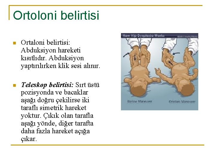 Ortoloni belirtisi n Ortaloni belirtisi: Abduksiyon hareketi kısıtlıdır. Abduksiyon yaptırılırken klik sesi alınır. n Ortoloni belirtisi n Ortaloni belirtisi: Abduksiyon hareketi kısıtlıdır. Abduksiyon yaptırılırken klik sesi alınır. n