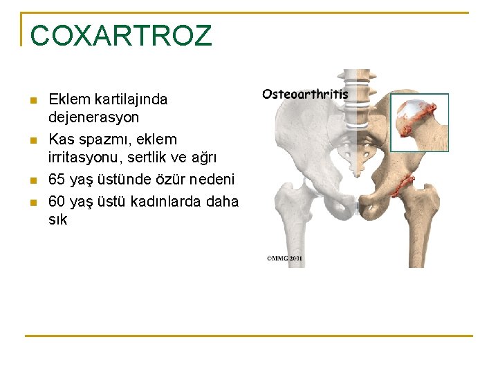 COXARTROZ n n Eklem kartilajında dejenerasyon Kas spazmı, eklem irritasyonu, sertlik ve ağrı 65 COXARTROZ n n Eklem kartilajında dejenerasyon Kas spazmı, eklem irritasyonu, sertlik ve ağrı 65