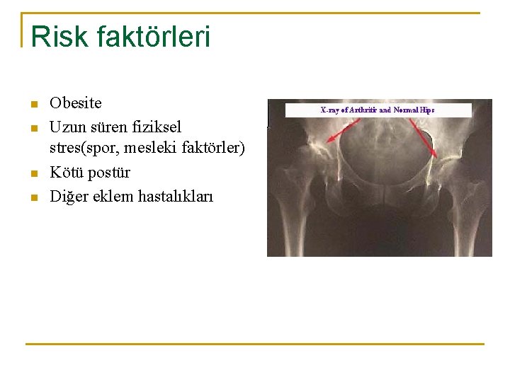 Risk faktörleri n n Obesite Uzun süren fiziksel stres(spor, mesleki faktörler) Kötü postür Diğer Risk faktörleri n n Obesite Uzun süren fiziksel stres(spor, mesleki faktörler) Kötü postür Diğer