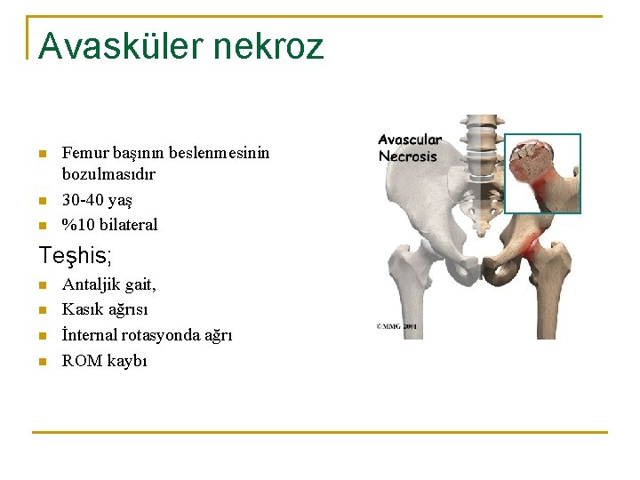 Avasküler nekroz n n n Femur başının beslenmesinin bozulmasıdır 30 -40 yaş %10 bilateral Avasküler nekroz n n n Femur başının beslenmesinin bozulmasıdır 30 -40 yaş %10 bilateral