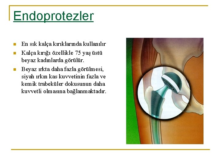 Endoprotezler n n n En sık kalça kırıklarında kullanılır Kalça kırığı özellikle 75 yaş Endoprotezler n n n En sık kalça kırıklarında kullanılır Kalça kırığı özellikle 75 yaş