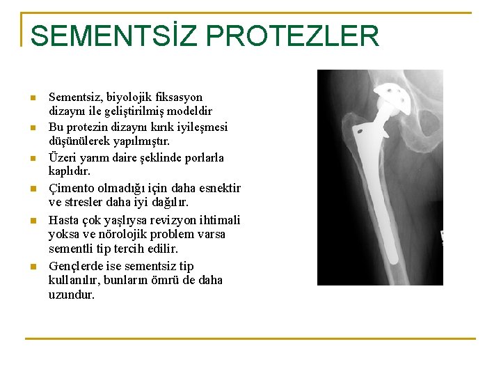 SEMENTSİZ PROTEZLER n n n Sementsiz, biyolojik fiksasyon dizaynı ile geliştirilmiş modeldir Bu protezin SEMENTSİZ PROTEZLER n n n Sementsiz, biyolojik fiksasyon dizaynı ile geliştirilmiş modeldir Bu protezin