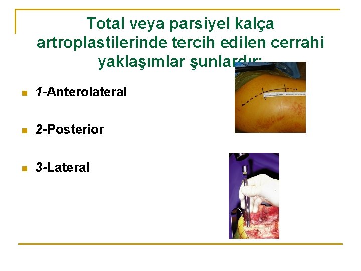 Total veya parsiyel kalça artroplastilerinde tercih edilen cerrahi yaklaşımlar şunlardır: n 1 -Anterolateral n Total veya parsiyel kalça artroplastilerinde tercih edilen cerrahi yaklaşımlar şunlardır: n 1 -Anterolateral n