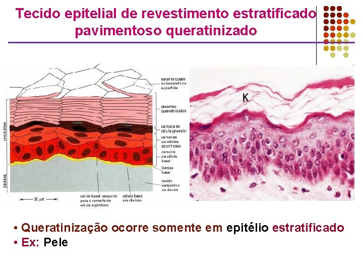 Tecido epitelial de revestimento estratificado pavimentoso queratinizado • Queratinização ocorre somente em epitélio estratificado