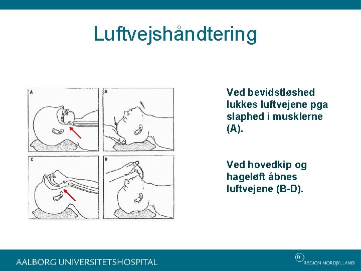 Luftvejshåndtering Ved bevidstløshed lukkes luftvejene pga slaphed i musklerne (A). Ved hovedkip og hageløft