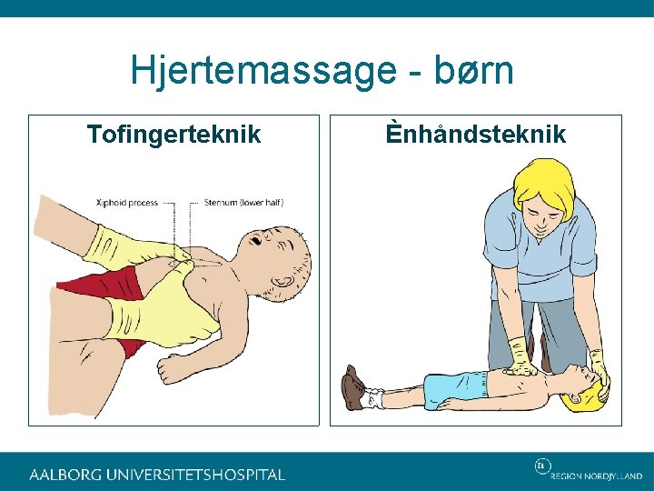 Hjertemassage - børn Tofingerteknik Ènhåndsteknik 