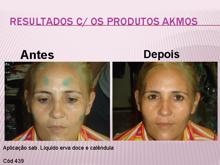 RESULTADOS C/ OS PRODUTOS AKMOS Antes Aplicação sab. Líquido erva doce e calêndula Cód