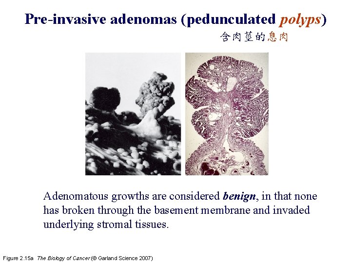 Pre-invasive adenomas (pedunculated polyps) 含肉莖的息肉 Adenomatous growths are considered benign, in that none has