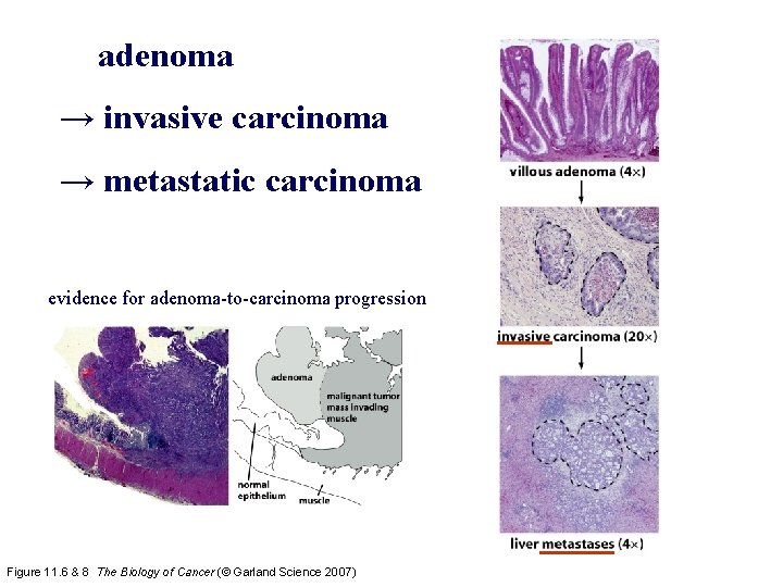 adenoma → invasive carcinoma → metastatic carcinoma normal liver tissue evidence for adenoma-to-carcinoma progression