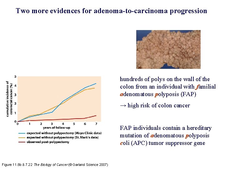 Two more evidences for adenoma-to-carcinoma progression hundreds of polys on the wall of the