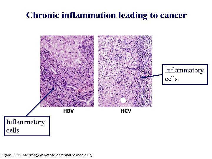 Chronic inflammation leading to cancer Inflammatory cells Figure 11. 35 The Biology of Cancer
