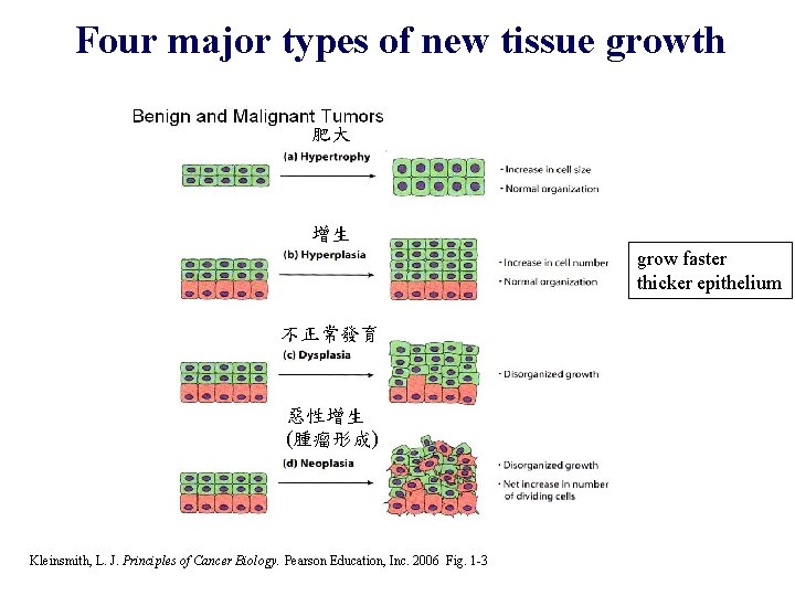 Four major types of new tissue growth 肥大 增生 grow faster thicker epithelium 不正常發育