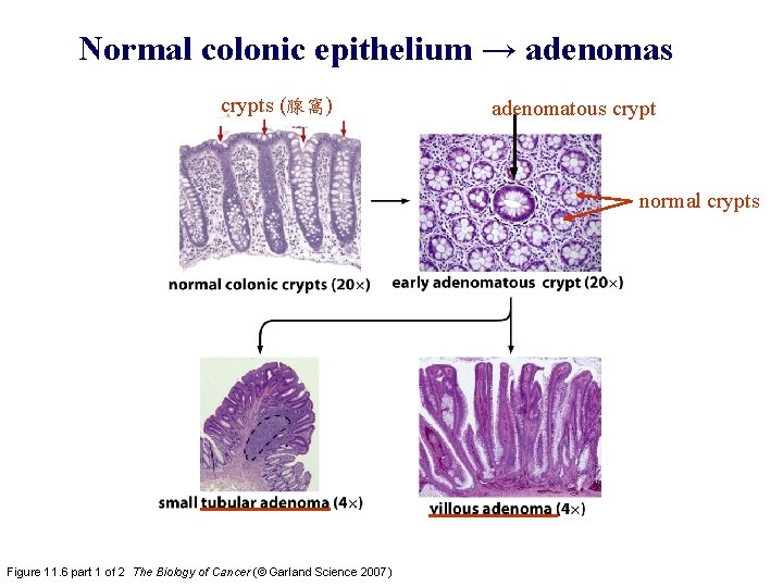 Normal colonic epithelium → adenomas crypts (腺窩) adenomatous crypt normal crypts Figure 11. 6