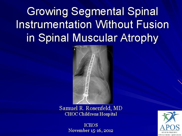 Growing Segmental Spinal Instrumentation Without Fusion in Spinal Muscular Atrophy Samuel R. Rosenfeld, MD