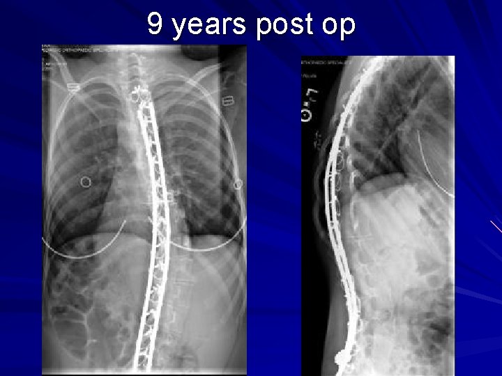 9 years post op 