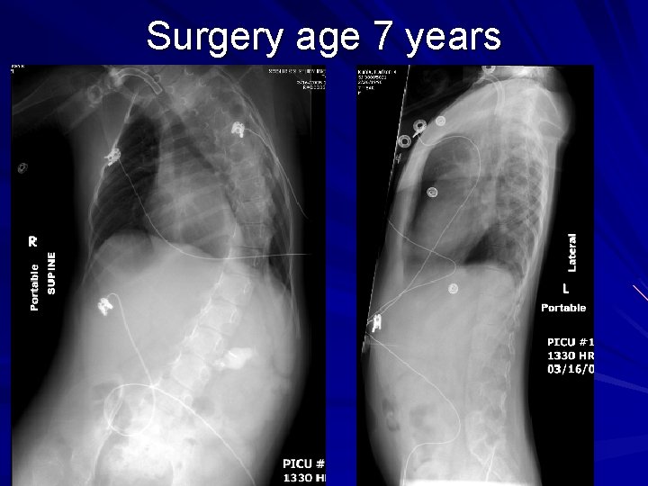 Surgery age 7 years 