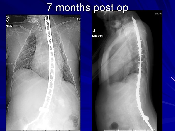 7 months post op 